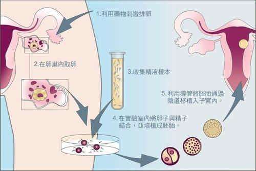 借卵子做试管婴儿行吗【借卵子做试管婴儿行吗？解读试管婴儿借卵子的利与弊】